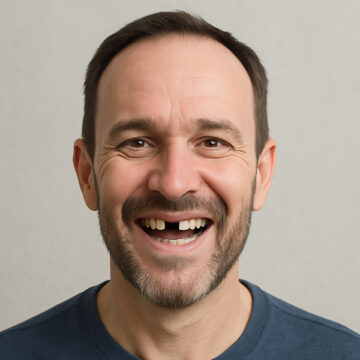 Congenitally Missing Teeth