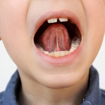 Is Your Frenulum Holding You Back?