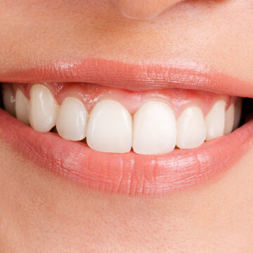 Why Straight Teeth?