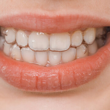 What To Do About White Spots