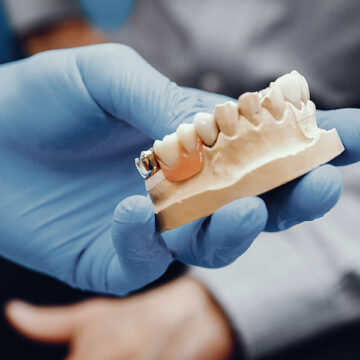 WHAT TO KNOW ABOUT  DENTAL CROWNS AND DENTAL BRIDGES?