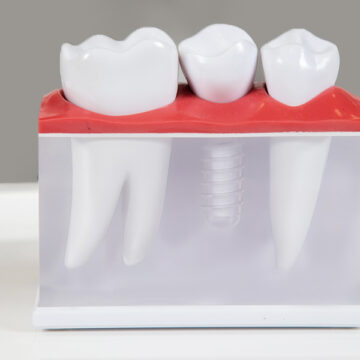 How Much Do Dental Implants Cost in Florida?