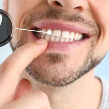 5 Care Tips for Your Dental Implant