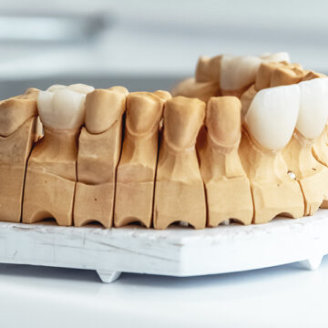 Do Porcelain Veneers Last Forever?