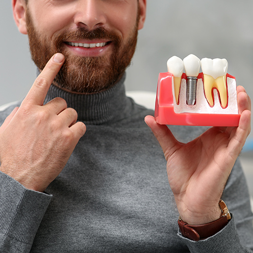 Dental Implants