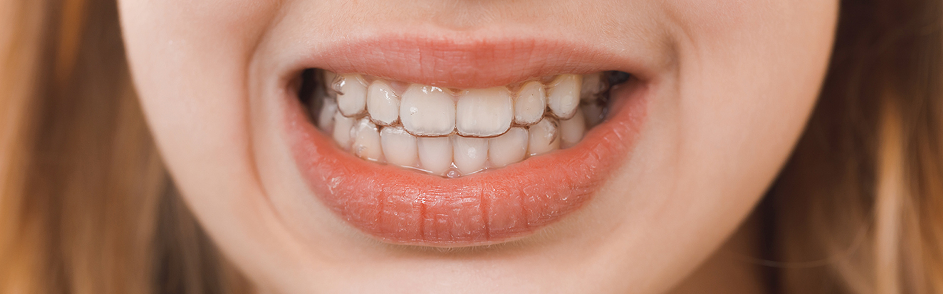What To Do About White Spots