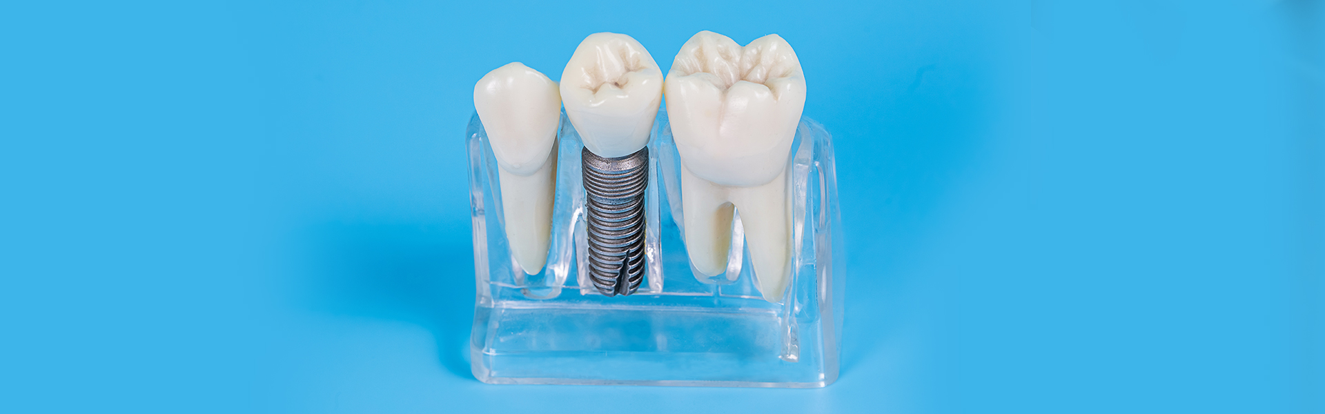 Dental Implants in Palm Coast, FL
