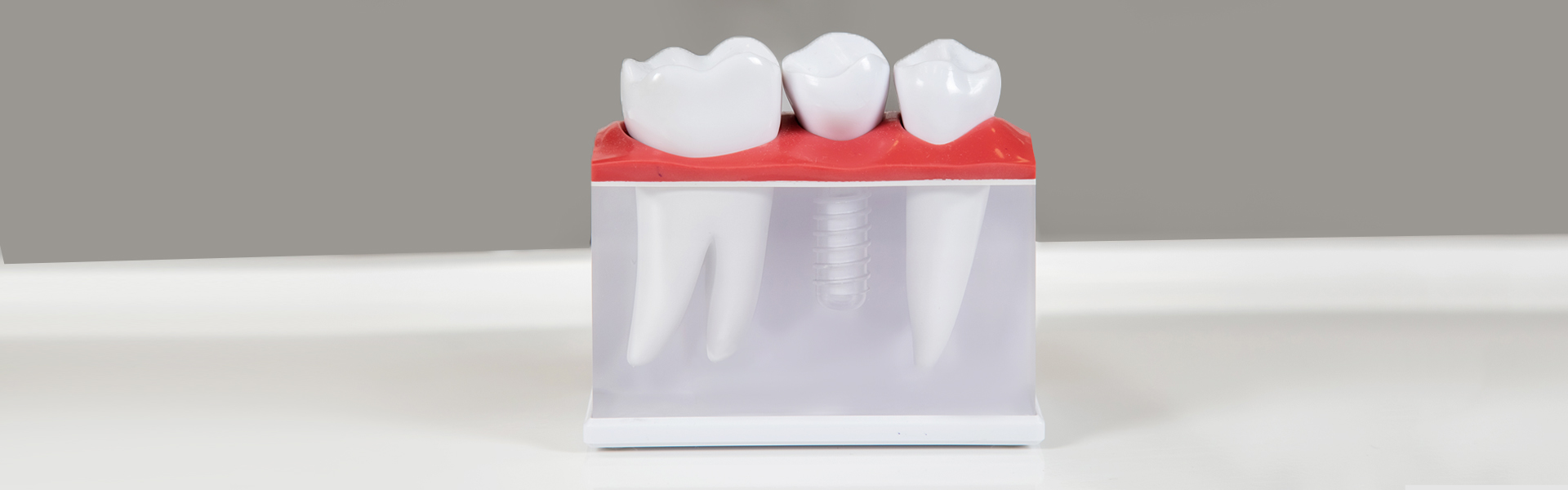 How Much Do Dental Implants Cost in Florida?