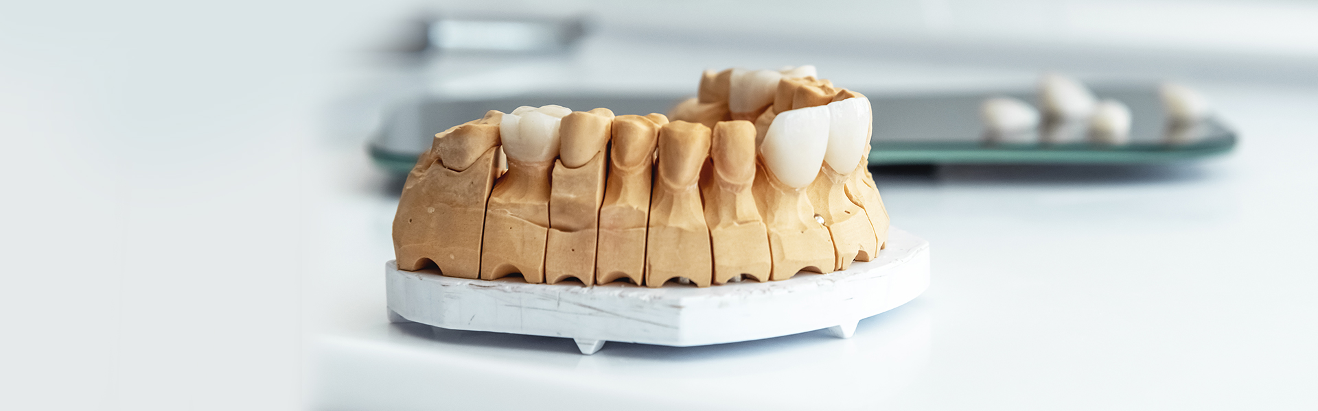 Do Porcelain Veneers Last Forever?