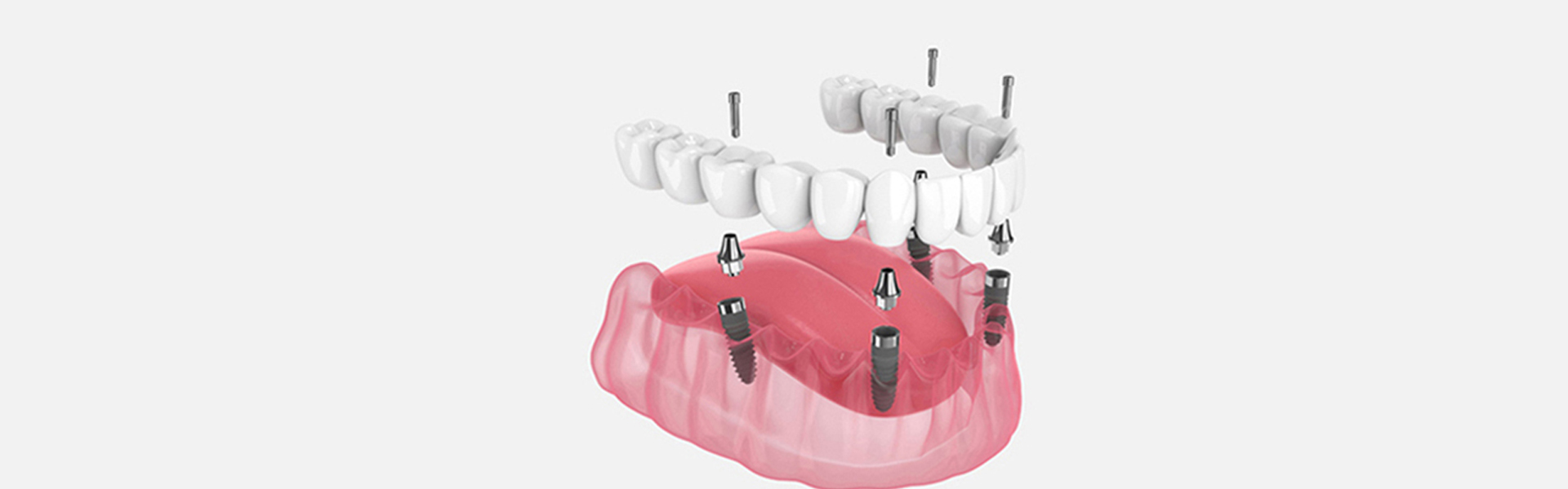 Debunking Six Common Myths About Dental Implants