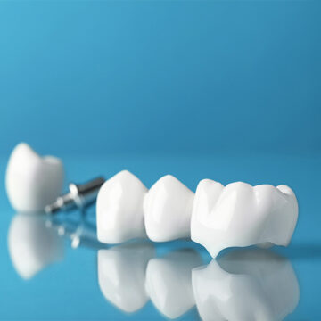 Same-Day Dental Crowns in Palm Coast, FL: What You Need to Know Before Booking