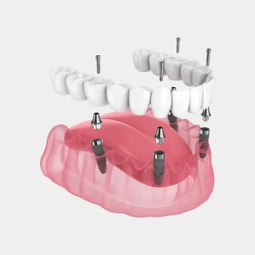 Are All-on-4 Dental Implants Worth It? Pros, Cons, and Real Results