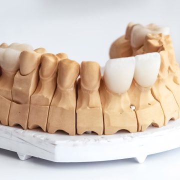 Crowns or Veneers for Damaged Teeth? Find the Right Treatment in Palm Coast, FL
